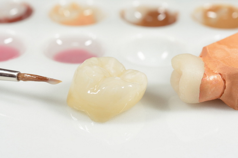 Are Dental Implant Coverd by I Surance?