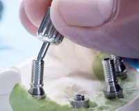 //iirorwxhloqjli5p.ldycdn.com/cloud/loBpkKloljSRrlpklkkijo/dental-abutment-implant.jpg