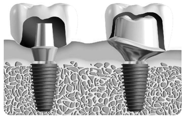How To Choose A High-Quality And Affordable Aftermarket Dental Abutment?