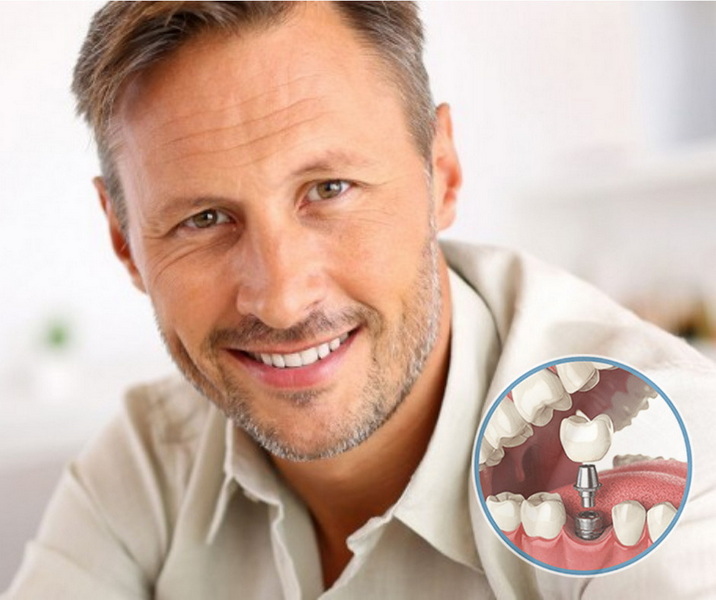 can i get one dental implant at a time