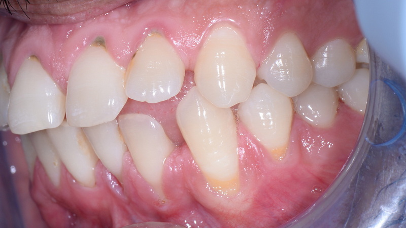can i use chloraseptic spray for dental implant pain