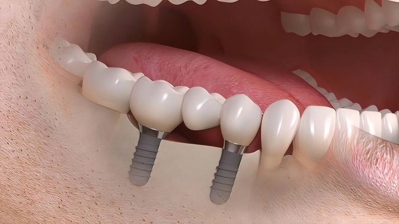 can body reject dental implant