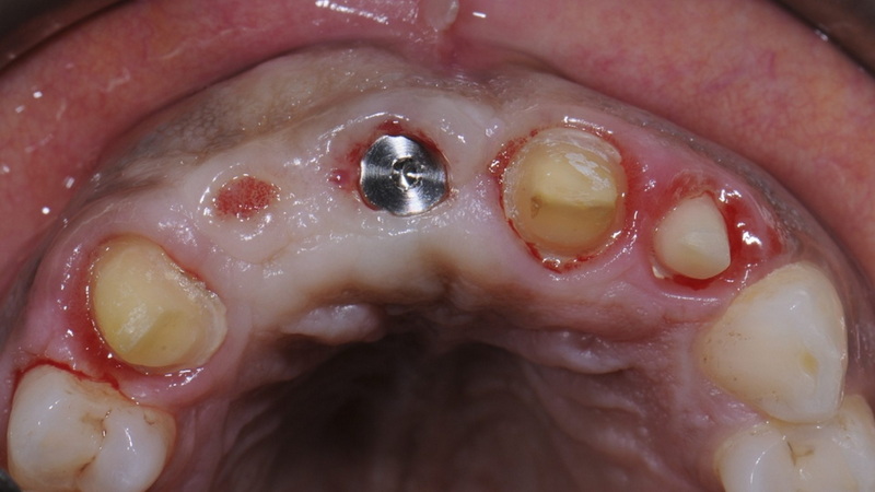 can a screw on a dental implant be too tight