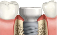 //iirorwxhloqjli5p.ldycdn.com/cloud/loBpkKloljSRrlrlkljmjo/astra-healing-abutment.jpg