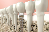 //iirorwxhloqjli5p.ldycdn.com/cloud/loBpkKloljSRrlrlnkimjo/neodent-healing-abutment-sizes.jpg