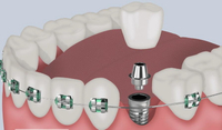 //iirorwxhloqjli5p.ldycdn.com/cloud/loBpkKloljSRrlrlpoikjo/can-you-get-a-dental-implant-with-braces-on.jpg