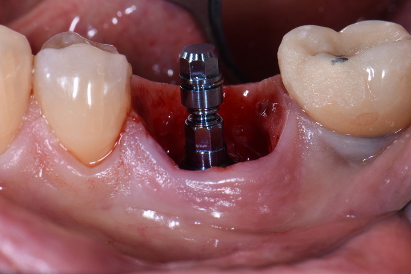 healing abutment screw fell out reddit