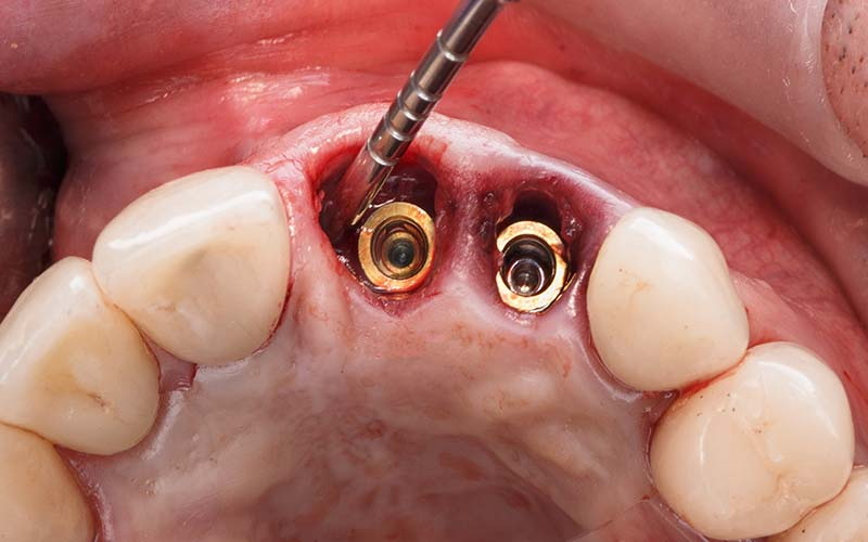 How To Tell If Dental Implant Is Infected?