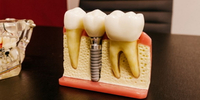 //iirorwxhloqjli5p.ldycdn.com/cloud/lpBpkKloljSRiliijjrqjn/individual-healing-abutment.jpg
