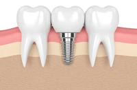 //iirorwxhloqjli5p.ldycdn.com/cloud/lpBpkKloljSRiliimrnqjo/healing-abutment-time.jpg