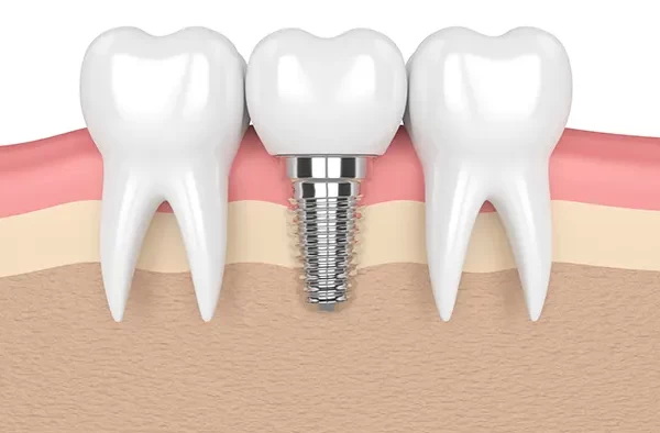 healing abutment time