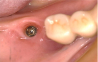//iirorwxhloqjli5p.ldycdn.com/cloud/lpBpkKloljSRilliiippjo/implant-abutment-screw-loosening-solution.jpg