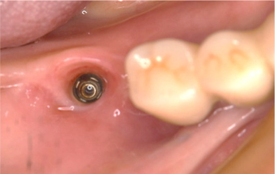 How Does Proper Torque Technique Prevent Abutment Screw Loosening?