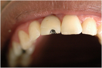 //iirorwxhloqjli5p.ldycdn.com/cloud/lpBpkKloljSRilliiknmjo/nobel-rp-healing-abutment.jpg