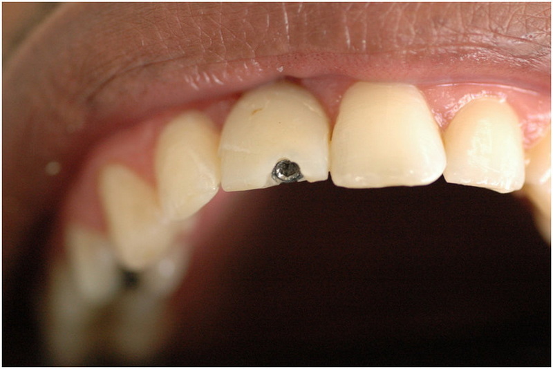 How To Properly Place And Torque A Nobel RP Healing Abutment?