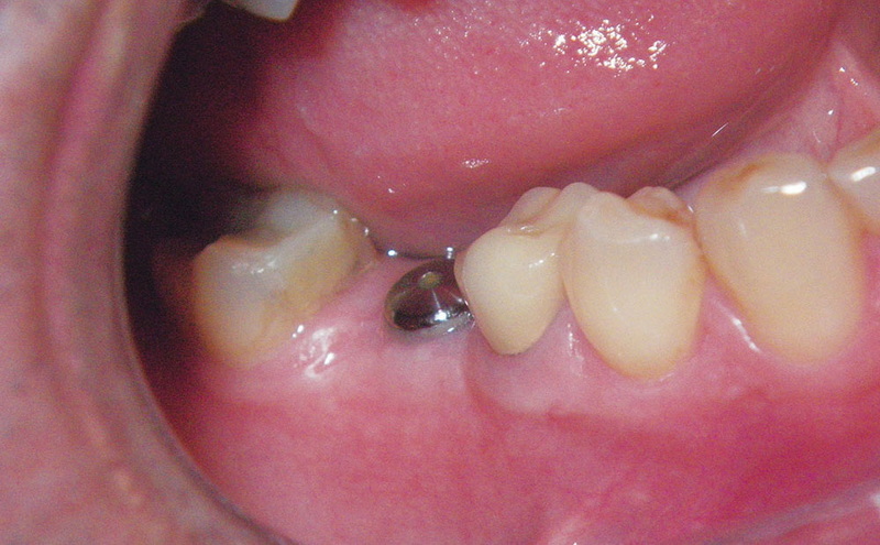 4.1 zimmer healing abutment size