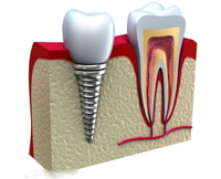 //iirorwxhloqjli5p.ldycdn.com/cloud/lpBpkKloljSRilmrlimrjo/total-cost-of-dental-abutment-and-crown.jpg