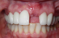 //iirorwxhloqjli5p.ldycdn.com/cloud/lpBpkKloljSRilnjmnmkjq/does-a-bone-graft-for-a-dental-implant-typically-cost.jpg