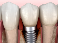 //iirorwxhloqjli5p.ldycdn.com/cloud/lpBpkKloljSRiloillknjo/mis-abutment-screw-torque.jpg