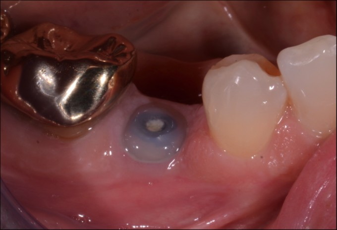 how many days for dental implant