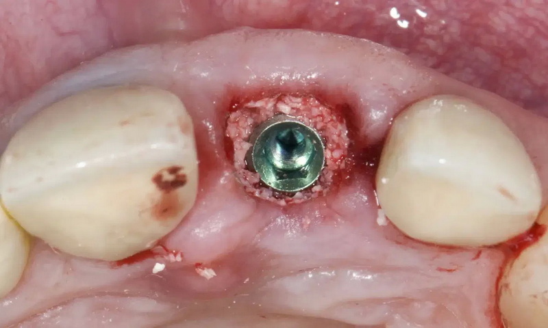 how much does a dental implant costs tucson
