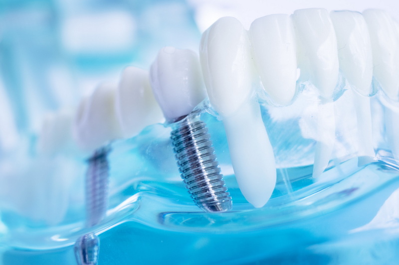 can brush your teeth after dental implant surgery_2