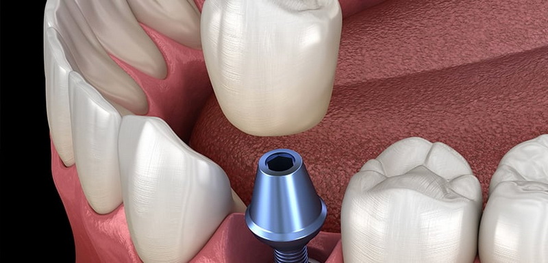 replace a dental implant_2