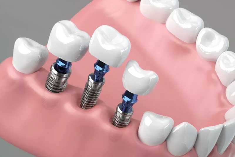 can dental implant be replaced_3