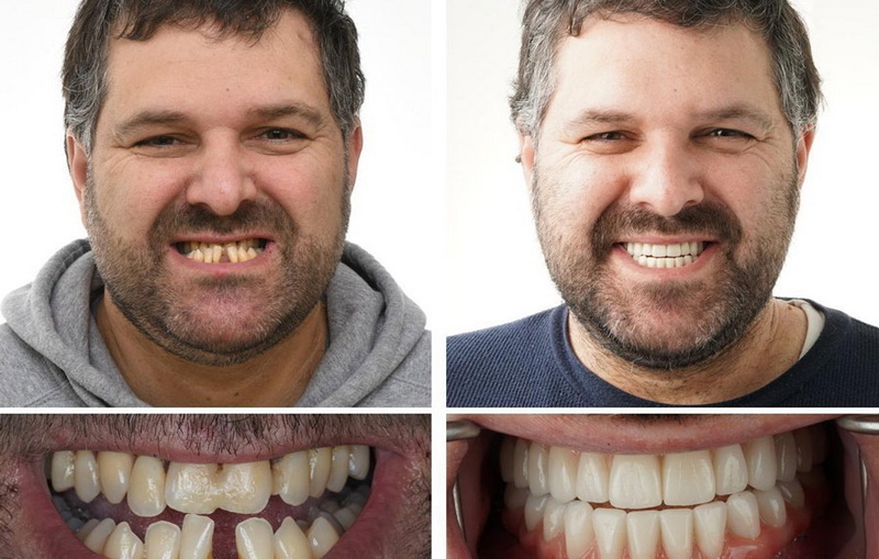 after dental implant_2