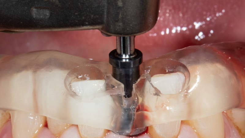 How To Treat Infected Dental Implant?