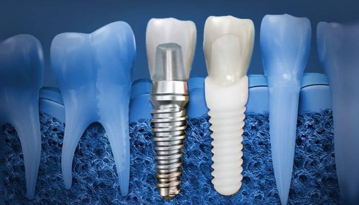when can eat solid food after dental implant_2
