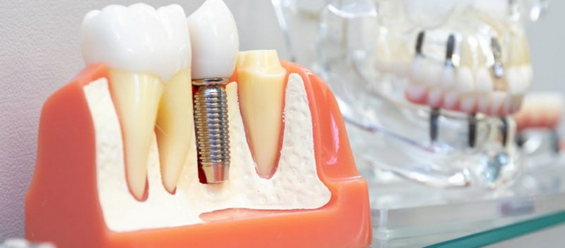 do i need a dental implant_1