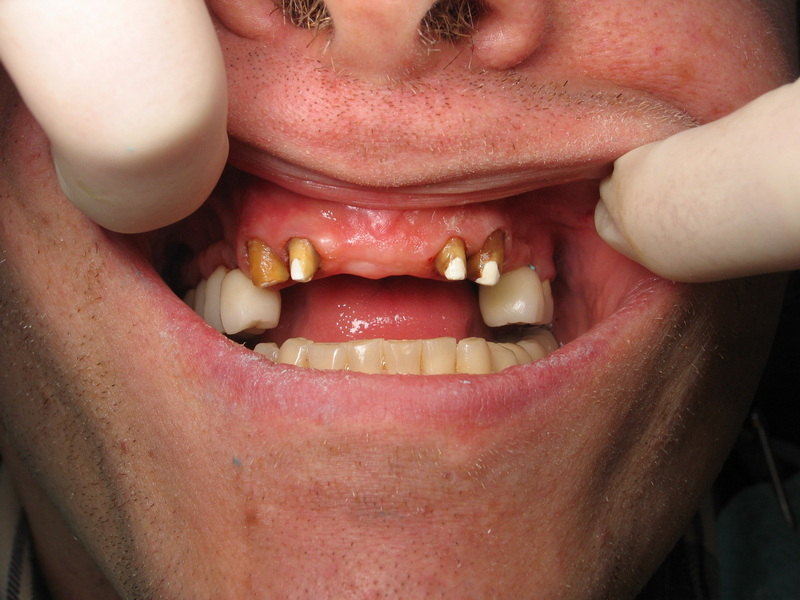not get a dental implant_1