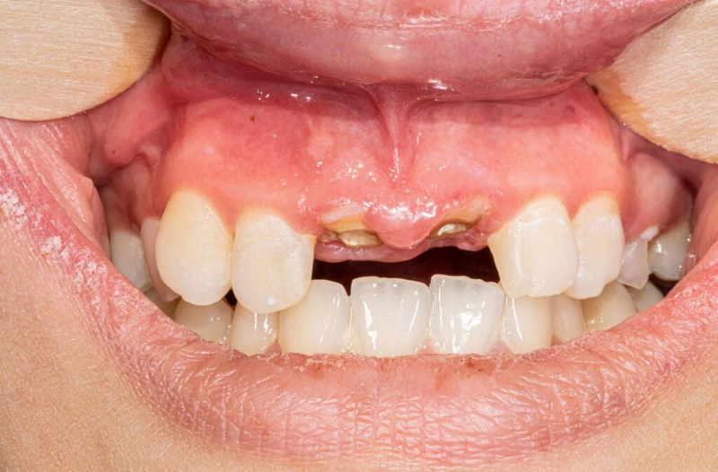 a dental implant_3