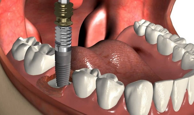 get instead of a dental implant_3