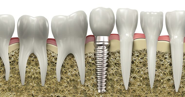 worth getting a dental implant_3