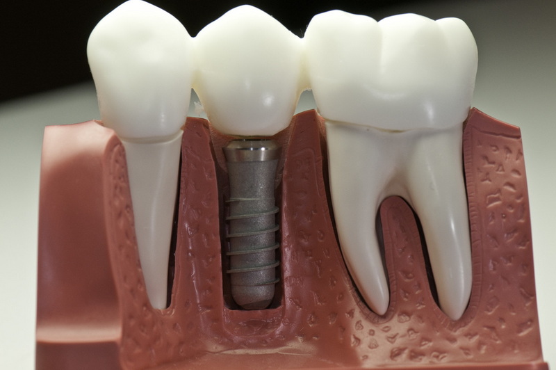 what happens if your dental implant fails_2