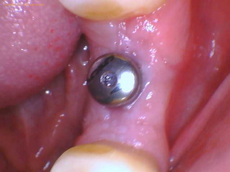can i screw the healing abutment back in_4