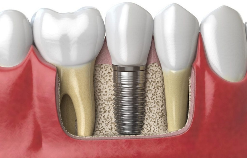 can dental implant be extended