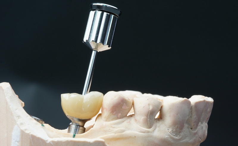 Does Dental Implant Affect Surrounding Teeth?