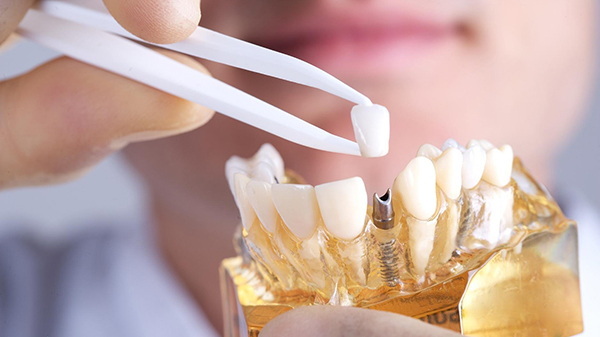 when can i drink hot coffee after dental implant