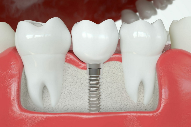 what is a dental implant annaplis