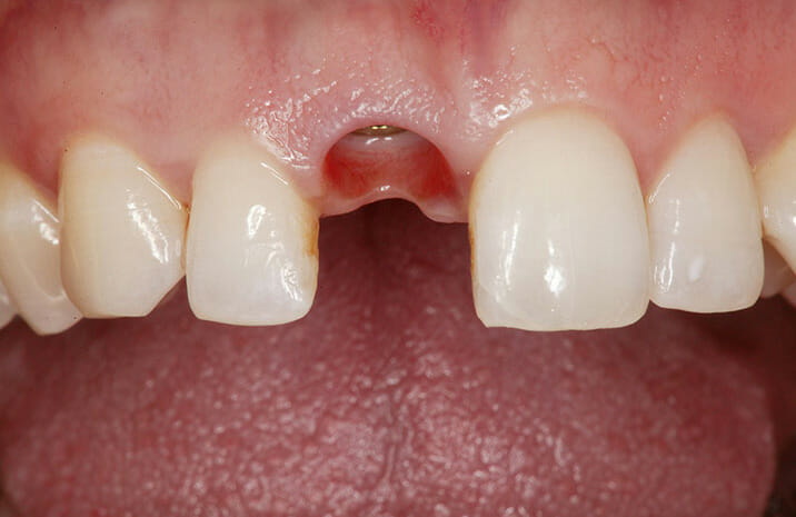 What Does Dental Implant Look Like before Crown?