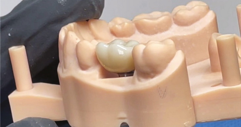 Can You Chew Gum with A Dental Implant?