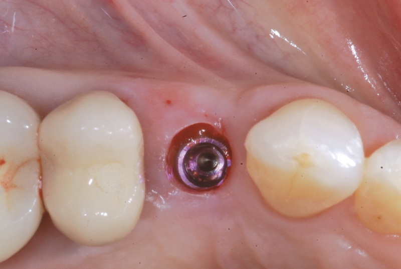 healing abutment torque