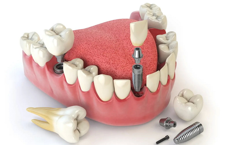 can you vape after a dental implant