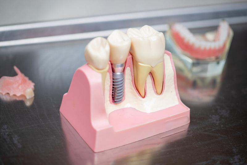 can you talk post dental implant surgery