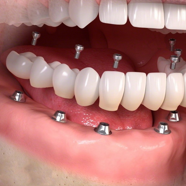 What To Expect During The Dental Abutment And Crown Procedure?