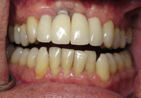 //iirorwxhloqjli5p.ldycdn.com/cloud/lpBpkKloljSRrlklnnoijo/cold-welding-dental-abutment-implant.jpg