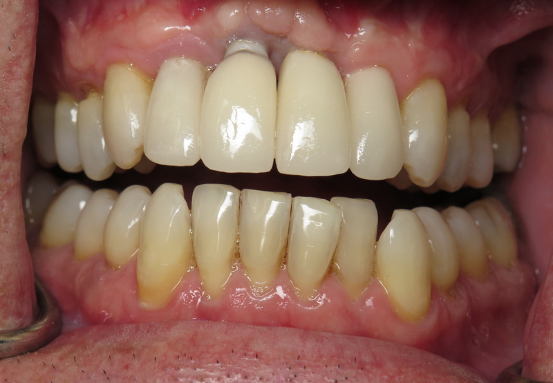cold welding dental abutment implant